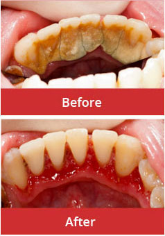 Dental Cleaning/Scaling