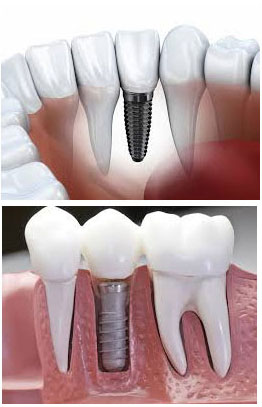 Dental Implants