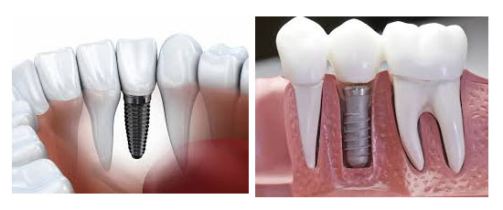 Dental Implants