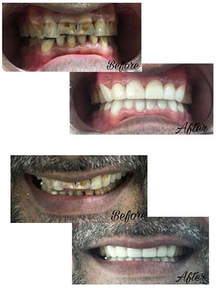 Full Mouth Reconstructions