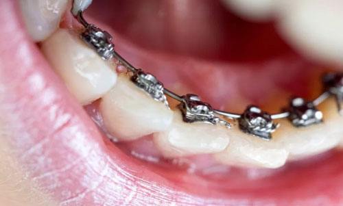 Lingual Braces