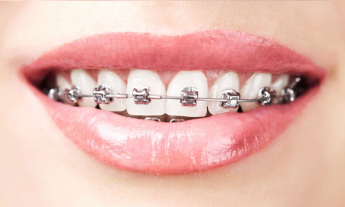 Metal Braces