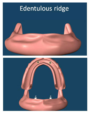 Implant supported overdentures