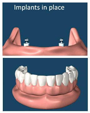 Implant supported overdentures