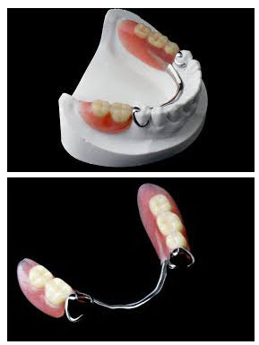 Partial Dentures