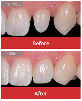 Porcelain Veneers