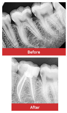 Symptoms Of A Root Canal