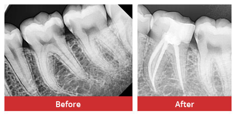 Symptoms Of A Root Canal