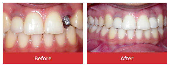 Single tooth implant