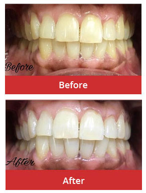 Teeth Whitening/ Dental Bleaching