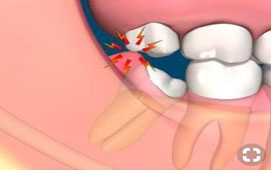 Wisdom Tooth Extraction