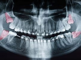 Wisdom Tooth Extraction